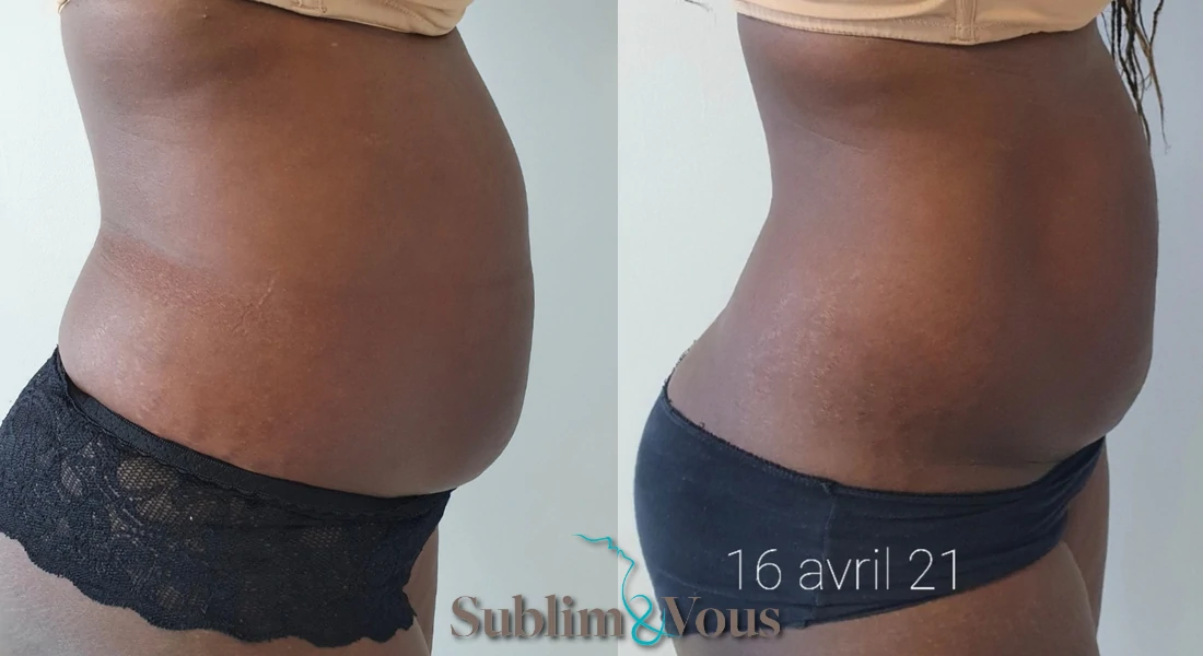 Traitements esthétiques du corps, affinement silhouette et traitement cellulite Médecine esthétique Guadeloupe - Dr Thouzery
